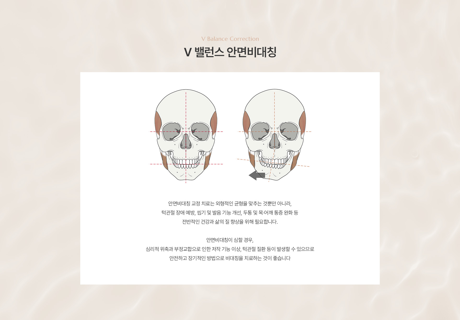 안면비대칭 상세03