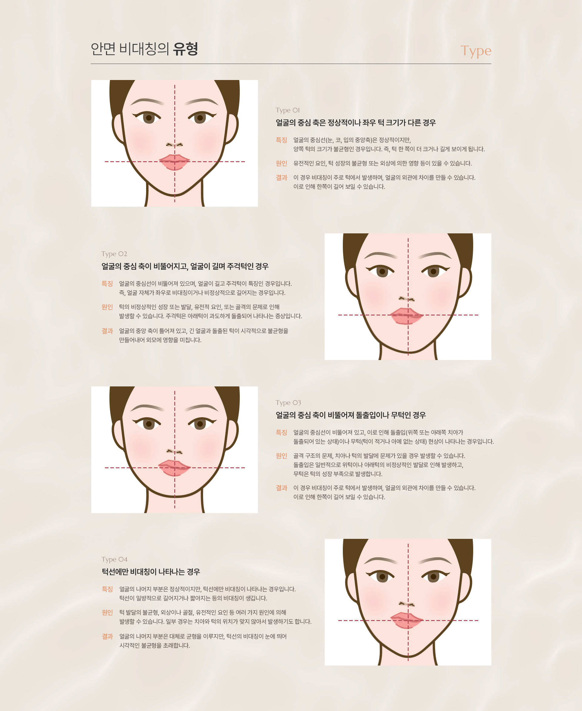 안면비대칭 교정 상세02