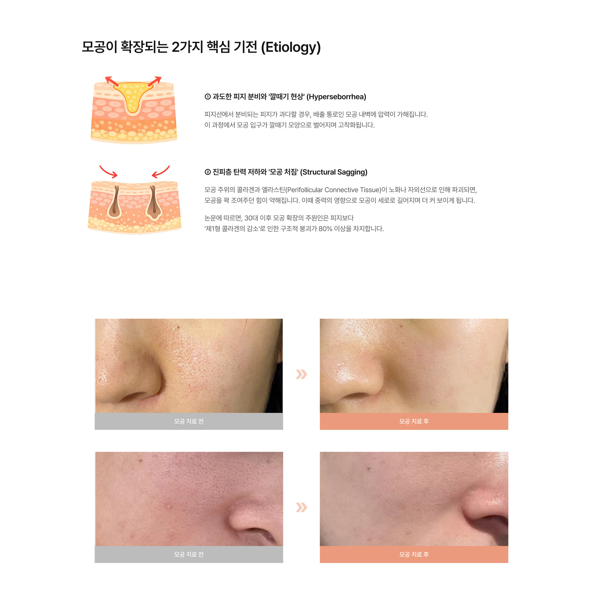 ODA 모공 리모델링 02