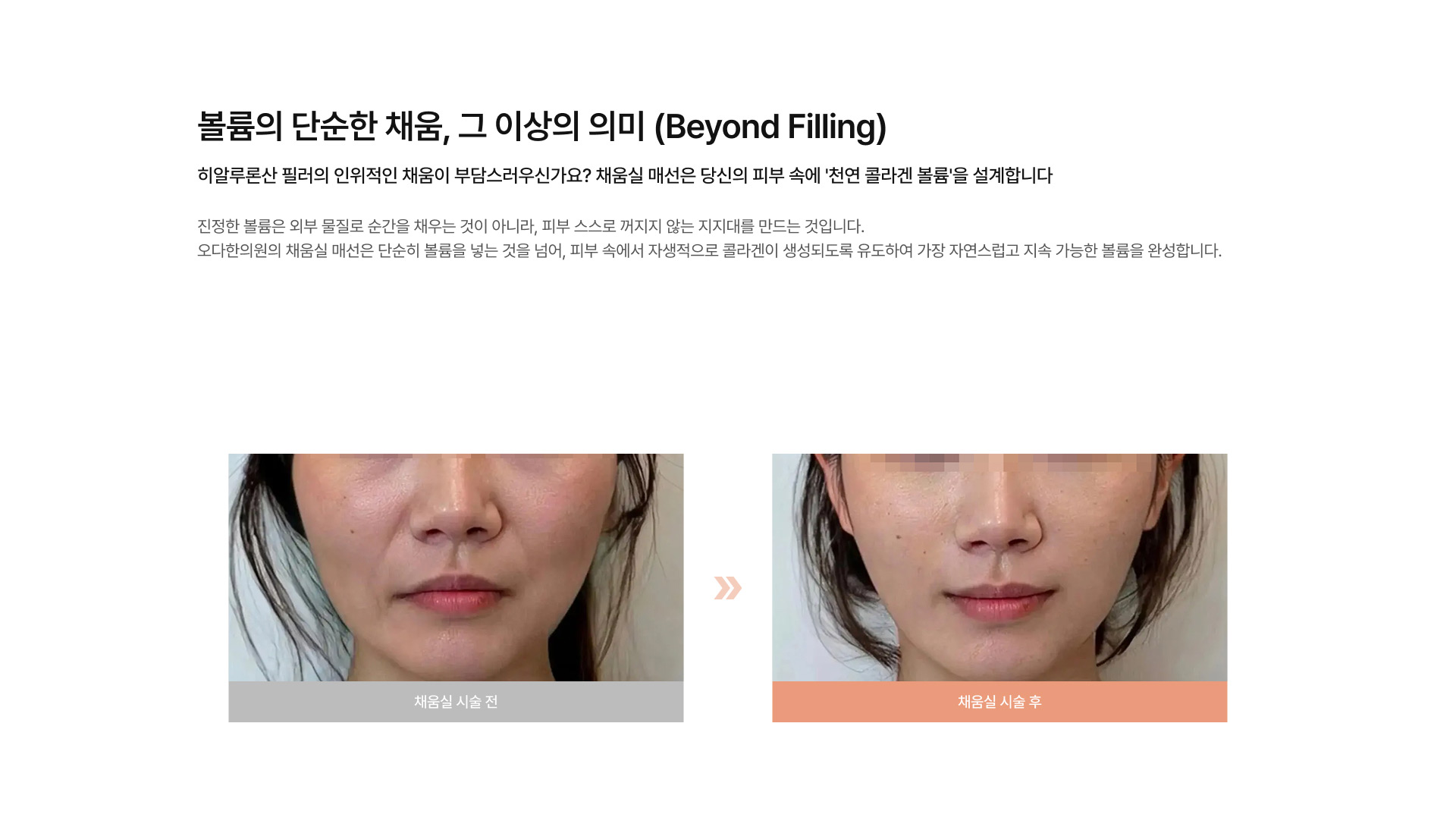 채움실 매선 01
