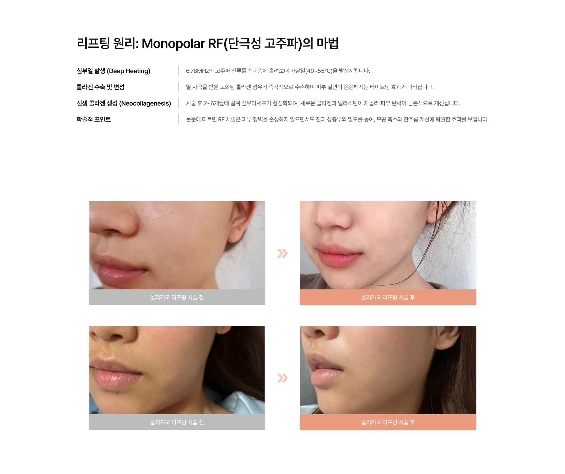 올리지오 리프팅 02