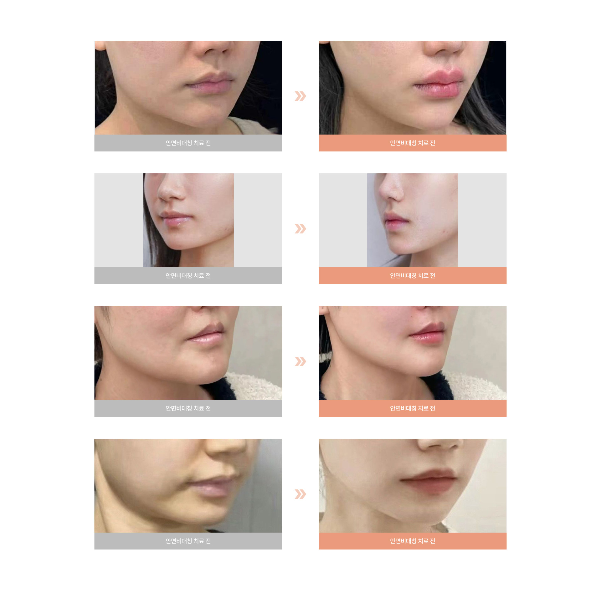 온다 리프팅 04