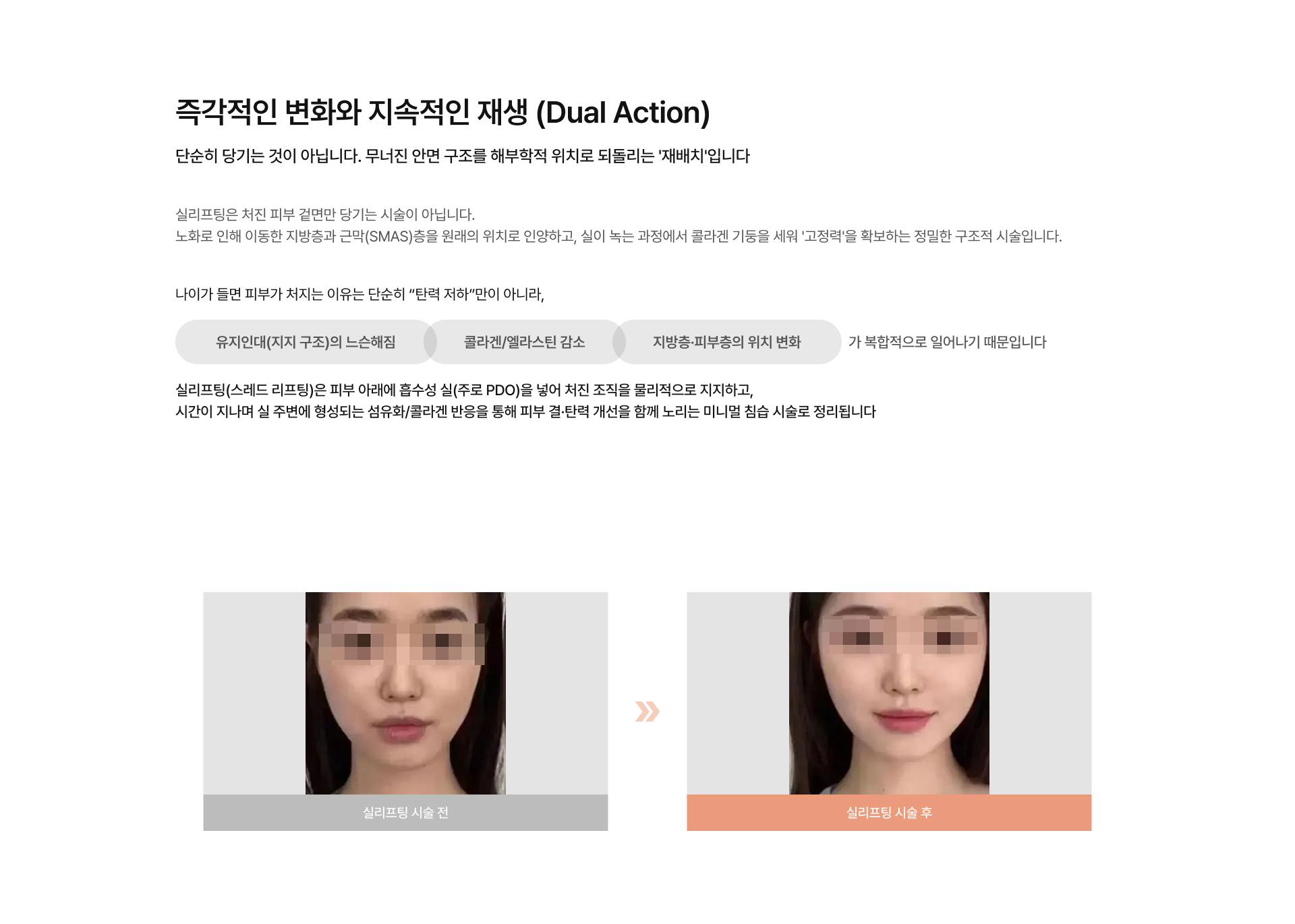 실리프팅 01