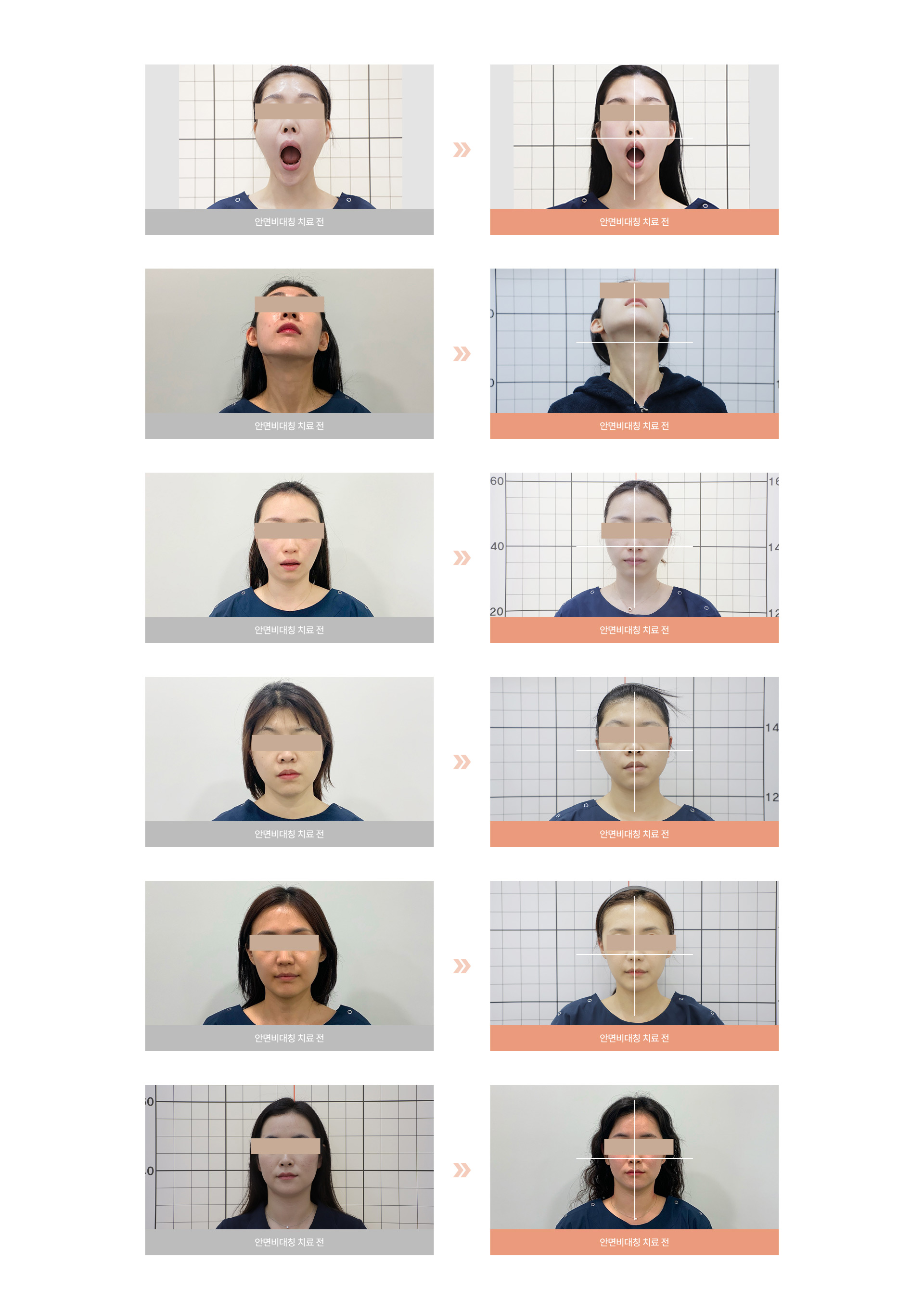 안면비대칭 교정 07