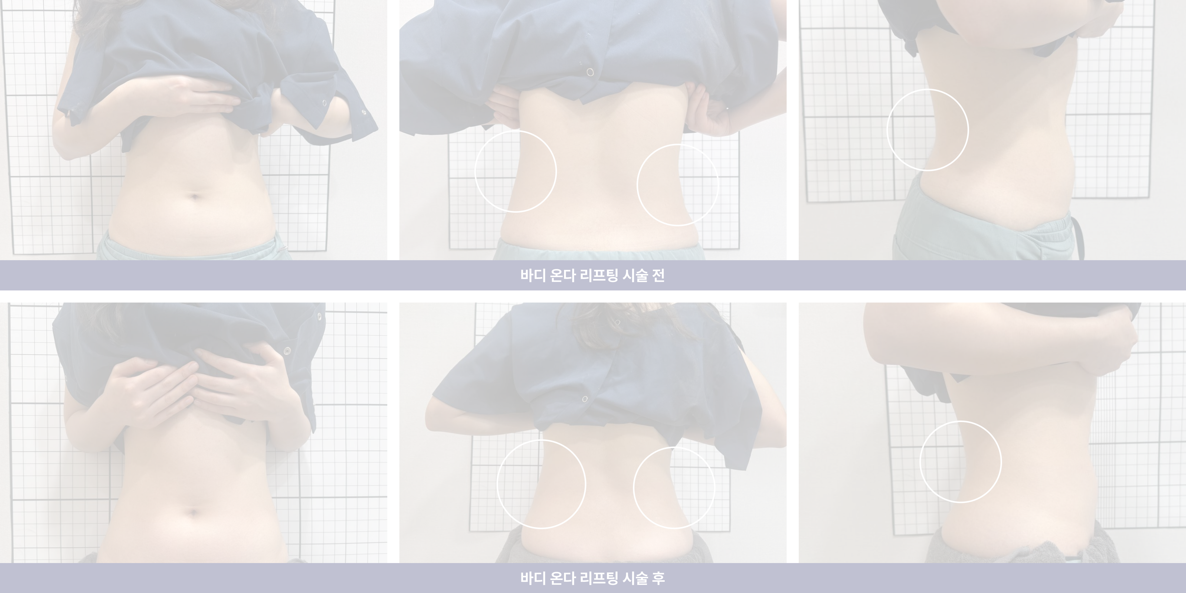 20대, 리프팅/주름/탄력, 바디 온다 리프팅